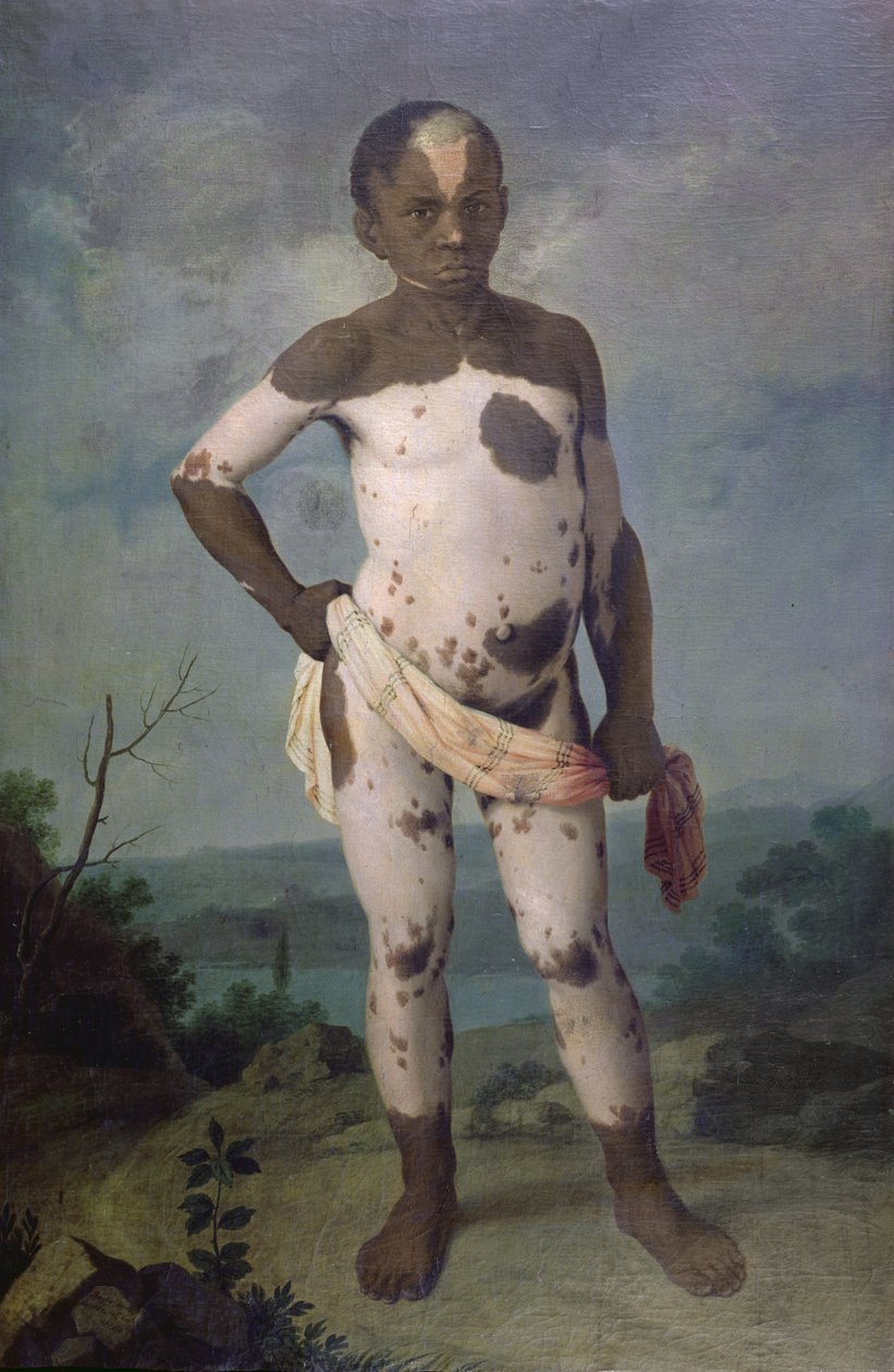Dziecko z bielactwem, 1786 autorstwa Brazilian School