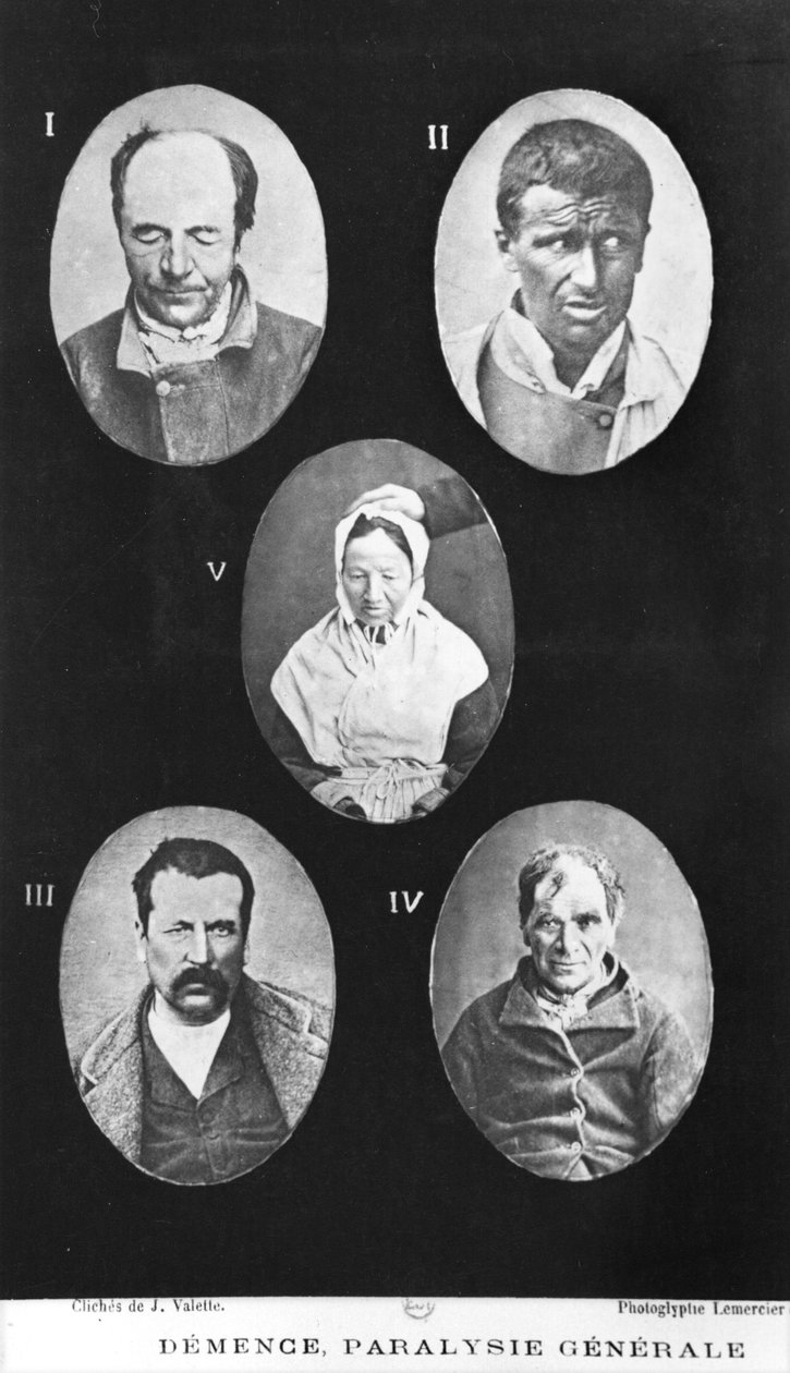 Demencja, Ogólny paraliż, ilustracja z Nowego podstawowego i praktycznego traktatu o chorobach psychicznych Henri Dagoneta (1823-1902) Paryż, Bailliere, 1876 autorstwa French Photographer