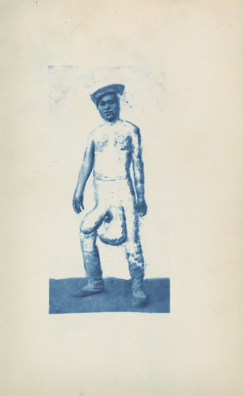 Elephantiasis, c. 1870 (zdjęcie) autorstwa Unknown photographer