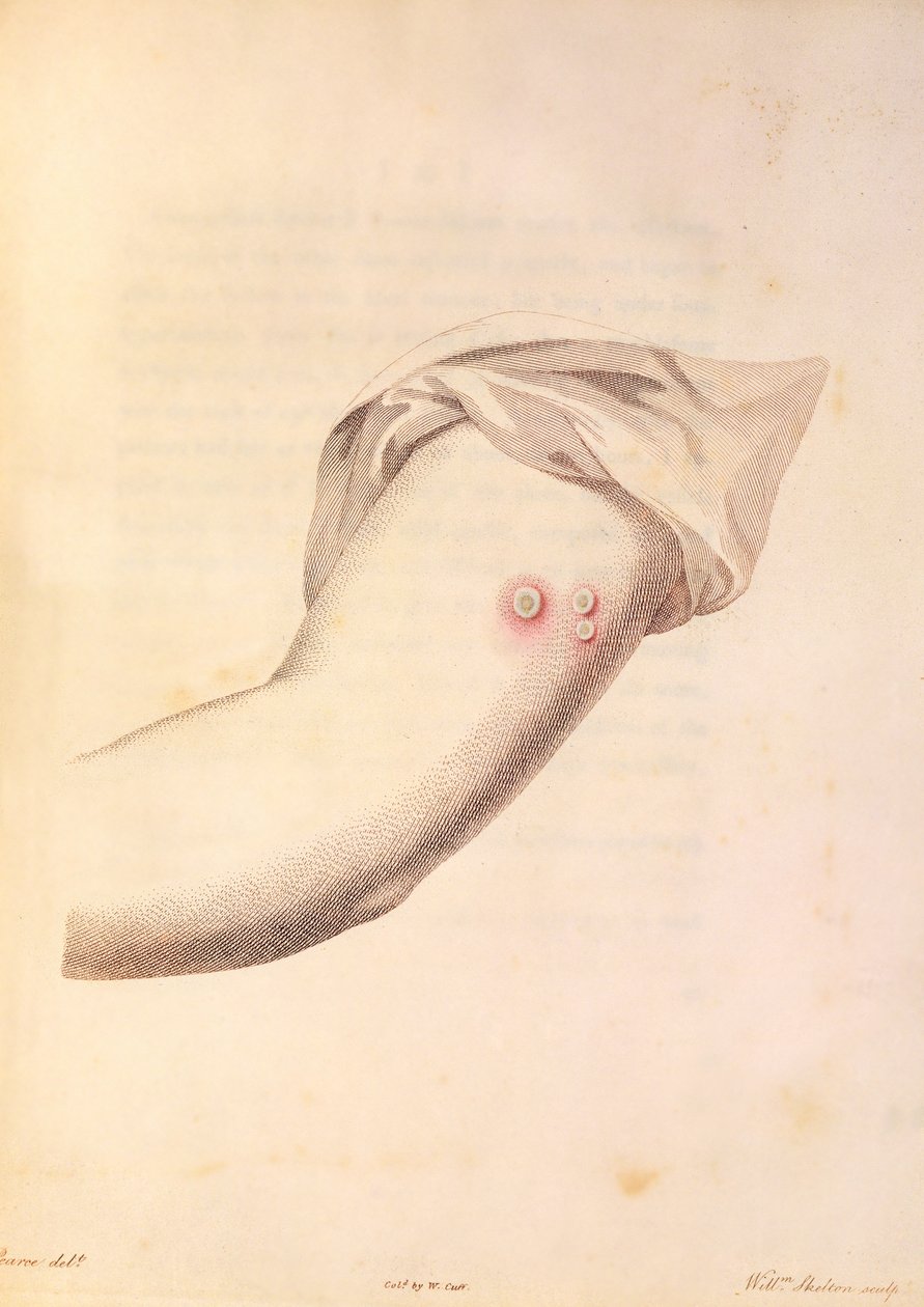 Ramię Williama Peada użyte do produkcji szczepionki przeciwko ospie prawdziwej, z książki "An Inquiry into the Causes and Effects of the Variolae Vaccinae" Edwarda Jennera (1748-1823), wyryte przez Pearce